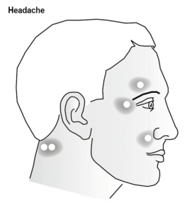 Headache side diagram 1
