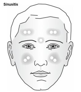 Sinusitis-diagram