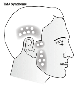 TMJ Syndrome diagram