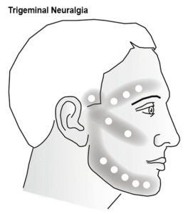 Trigeminal-Neuralgia-Diagram